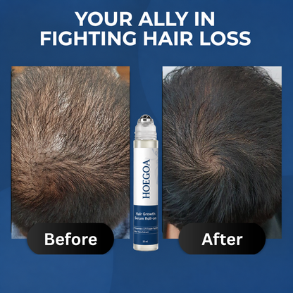Hoegoa™ Rosemary Hair Growth Roller